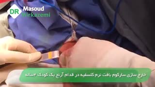 خارج سازی  سارکوم از آرنج