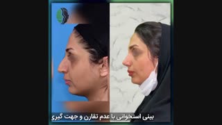 یکماه بعد از جراحی بینی استخوانی | دکتر باستانی نژاد | جراح بینی تهران
