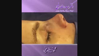 نتیجه عمل زیبایی بینی | دکتر سید رضا رفیع | جراح بینی تهران