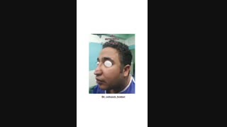 نتیجه عمل جراحی زیبایی بینی