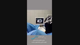 آى وى اف به چه صورت انجام میشه؟