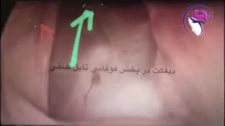 فیلم واقعی عمل ترمیم آندوسکوپی شکستگی قاعده جمجمه