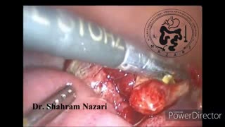 آپاندسیت حاد چرکی پاره شده / گانگرنه