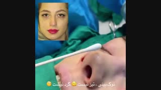 فیلم عمل  بینی به روش بسته