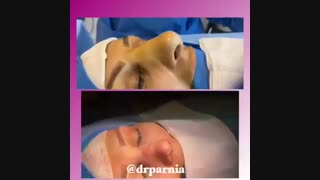 فیلم جراحی بینی توسط دکتر پرنیا