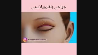 جراحی بلفاروپلاستی