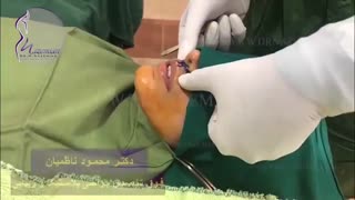 فیلم عمل لیفت لب
