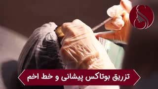 فیلم واقعی تزریق بوتاکس به پیشانی