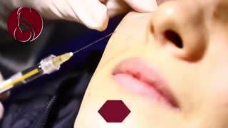 فیلم واقعی تزریق فیلر زیر چشم