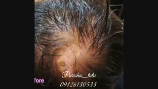 میکرو اسکالپ سر | 09126130533