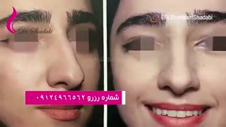 بلافاصله پس از جراحی بینی