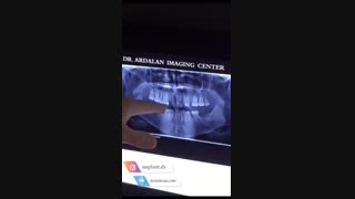 کاشت ایمپلنت دندان بدون جراحی لثه و خونریزی