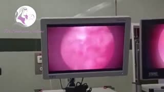 عمل هیستروسکوپی آشرمن