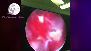 عمل هیستروسکوپی سپتوم