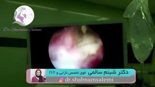 عمل هیستروسکوپی فیبروم رحم