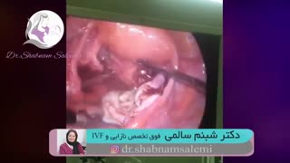 لاپاراسکوپی کیست اندومتریوما دو طرفه