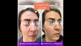 تزریق فیلر در گونه و خط خنده و اطراف لب