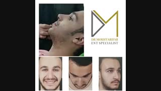 جراحی زیبایی بینی به فرم طبیعی بلافاصله پس از برداشتن اسپلینت بینی