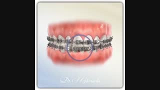 درمان انحراف میدلاین با استفاده از کش ارتودنسی | دکتر سعید قریشی