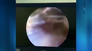 فیلم جراحی شانه - ترمیم روتاتورکاف