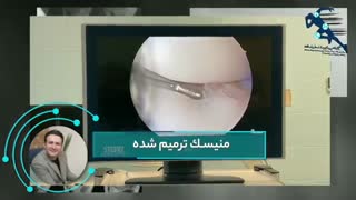فیلم عمل منیسک زانو