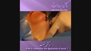 فیلم عمل ساکشن غبغب | دکتر سید رضا رفیع | جراح پلاستیک تهران