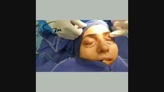 جراحی پلک پایین