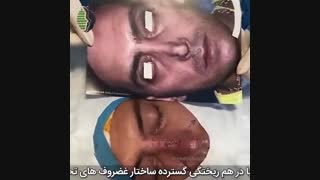 جراحی ترمیمی بینی با در هم ریختگی شدید غضروف های تحتانی | دکتر باستانی نژاد | جراح بینی