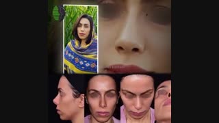 سه ماه بعد از جراحی ترمیمی بینی کوتاه با روش جدید دکتر باستانی نژاد | جراح بینی تهران