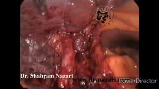 آژنزی یا فقدان مادرزادی کیسه صفرا