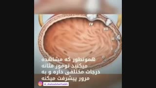 فیلم علت سوزش ادرار و خون در مثانه