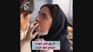 تزریق فیلر به خط خنده برداشتن خال گوشتی