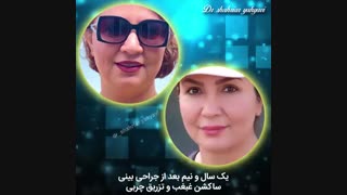 جراحی بینی ، ساکشن غبغب و تزریق چربی