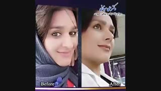 دو ماه بعد از عمل بینی