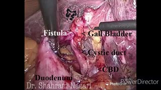 Cholecystoduodenal fistula