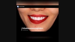 بهترین لمینت سرامیکی دندان (دکتر بهمن پوراقدم) 02122220000