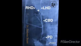 Junction of the Cystic Duct to Right Hepatic Duct