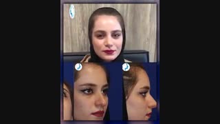 رضایت بیمار یک ماه بعد از جراحی زیبایی بینی | متخصص گوش و حلق و بینی | دکتر محمد گلی