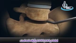 جراحی همجوشی دو استخوان | متخصص ارتوپد | دکتر محمد ابراهیم طاهریان