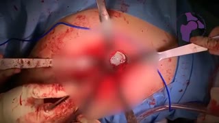 تعویض مفصل ران