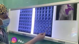 شکستگی گردن ران در جوانان