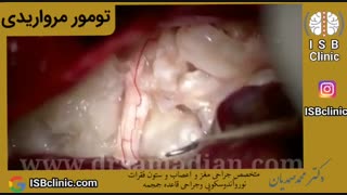 تومور مرواریدی