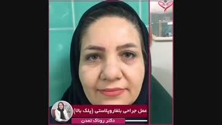 نمونه جراحی بلفاروپلاستی پلک از دکتر روناک تمدن