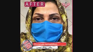 جراحی بلفاروپلاستی از دکتر روناک تمدن
