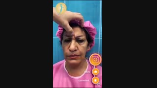 فیلم واقعی لیفت ابرو با اندوتاین