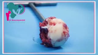 مراحل جراحی توتال هیپ در اتاق عمل