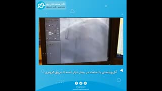 آنژیوپلاستی با استنت در بیمار دچار انسداد عروق کرونری