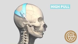 دستگاه هدگیر ارتودنسی | دکتر فرهاد گرجی دوز