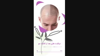 مراقبت های بعد از کاشت مو