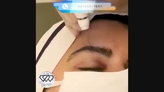 فیلم واقعی جوانسازی و رفع افتادگی پلک با پلاسماجت